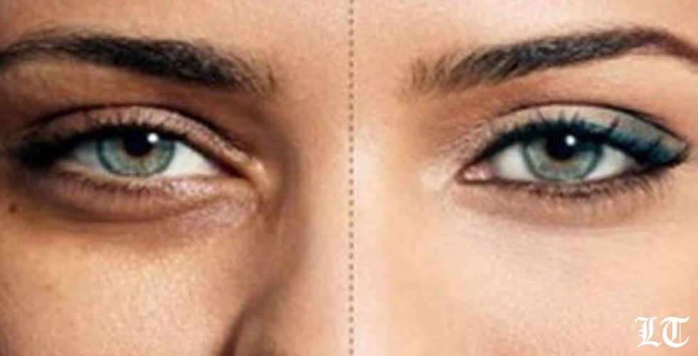 طرق معالجة الهالات السوداء تحت العينين